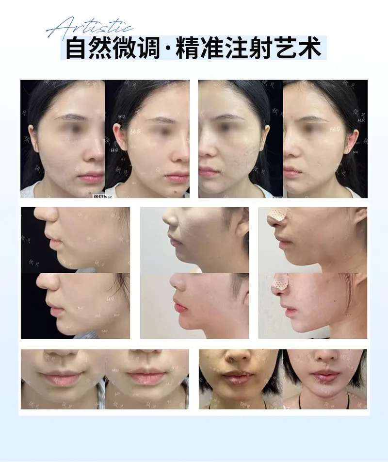 医美注射前后对比