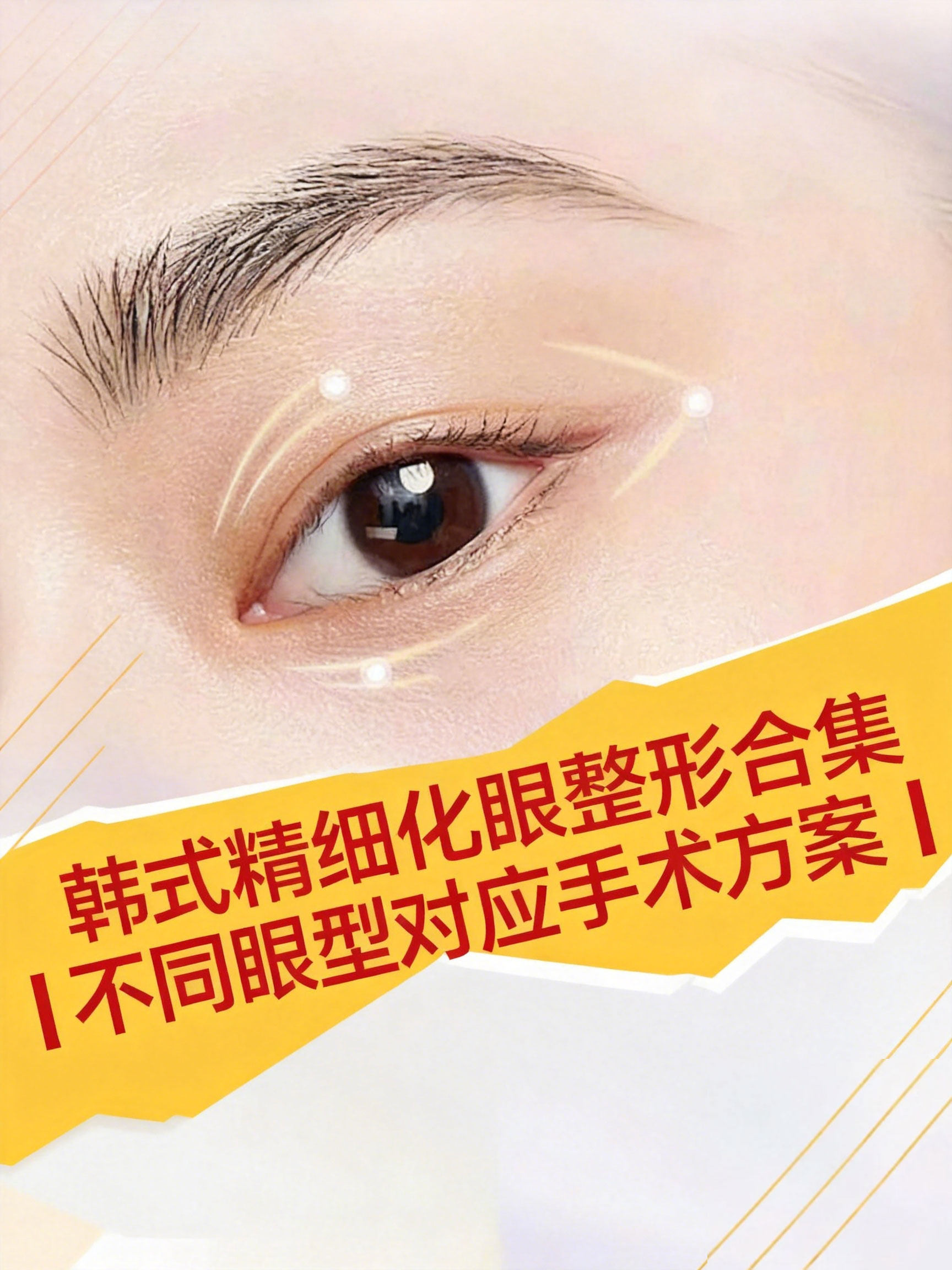 韩式精细化眼整形合集｜不同眼型对应手术方案