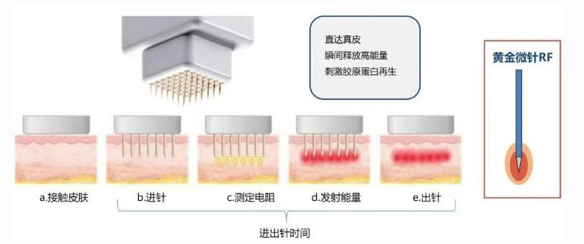 [DAYONE江南店]  黄金微针