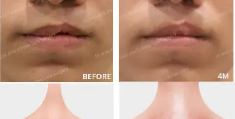 【nose】唇腭裂修复