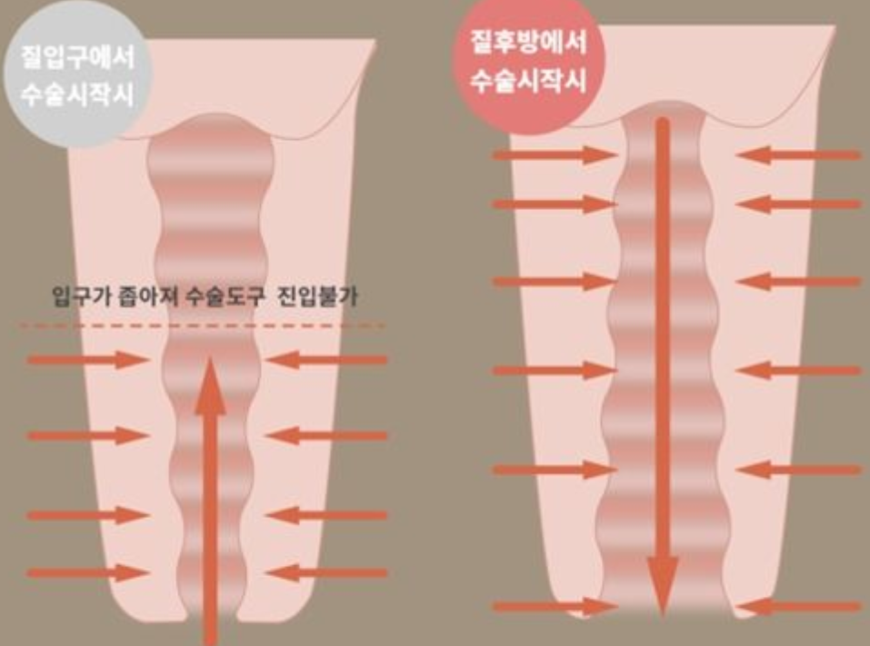 【好手艺医院】迷你阴道缩小手术
