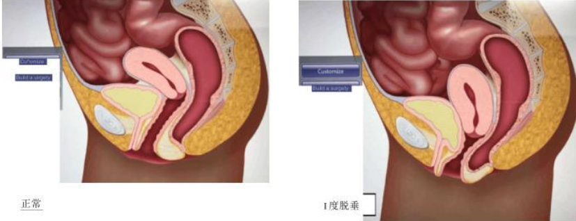 【好手艺医院】子宫下垂 1 度