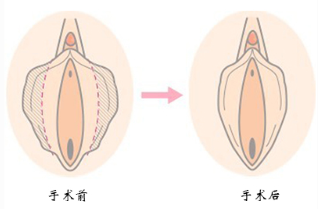 【好手艺医院】小阴唇整形手术