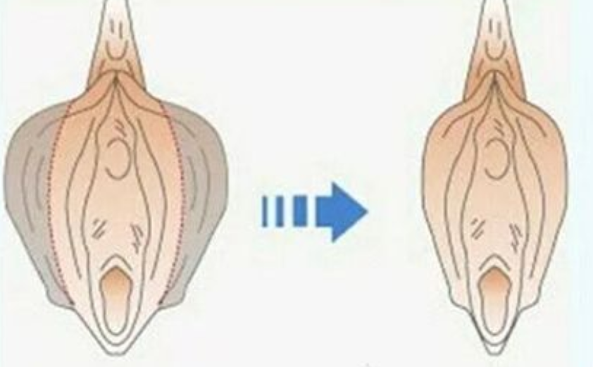 【好手艺医院】大阴唇手术
