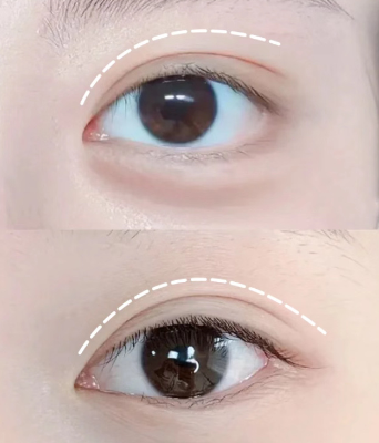 【 世美整形外科】眼睑提肌