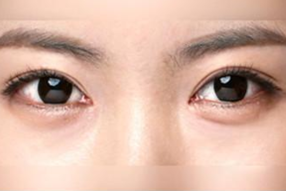 【ID 医院】下眼睑眼型矫正（下睑成形术）