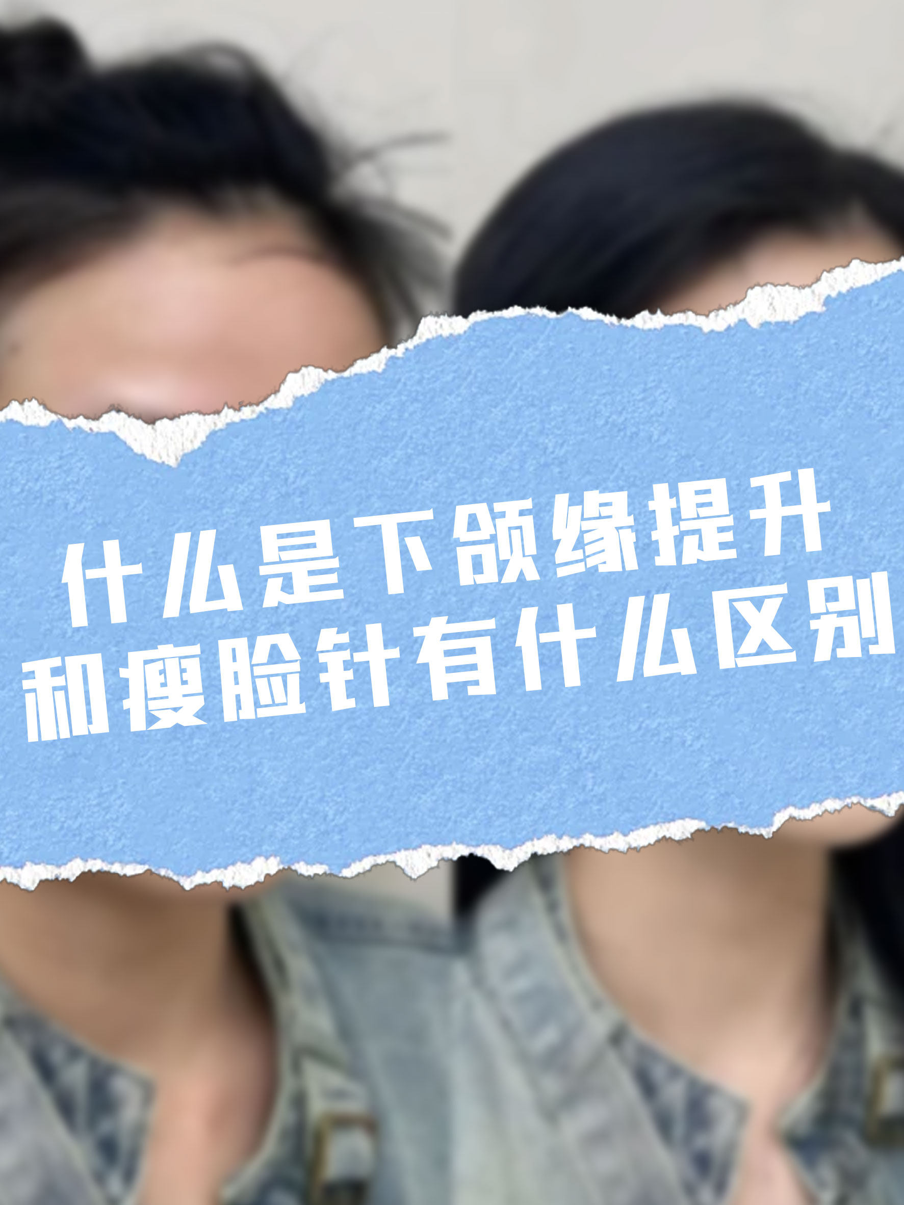 什麼是下頜緣提升？和瘦臉針有什麼區別