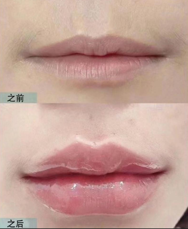 【济州 4EVER 皮肤科】玻尿酸丰唇 1CC+Meditoxin 嘴角肉毒