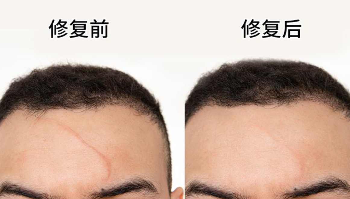【济州 4EVER 皮肤科】疤痕点阵激光（10mm 以内）
