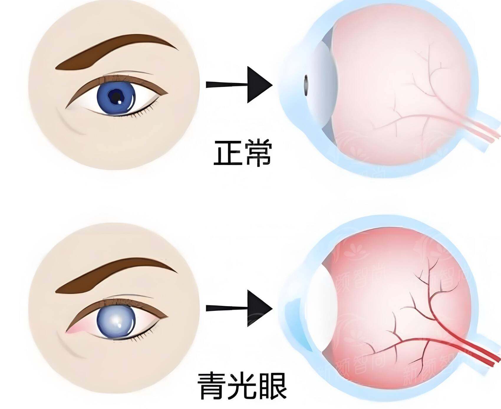 青光眼
