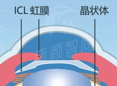 深圳新视代眼科医院白内障超声乳化+人工晶体植入术项目概述