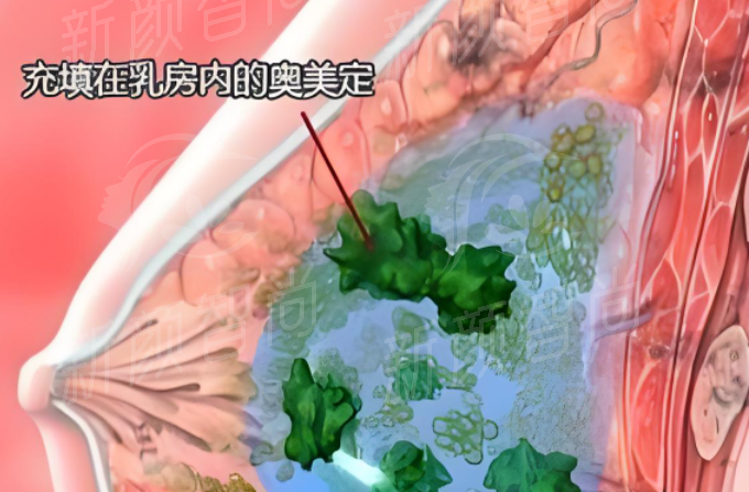 填充在乳房内的奥美定