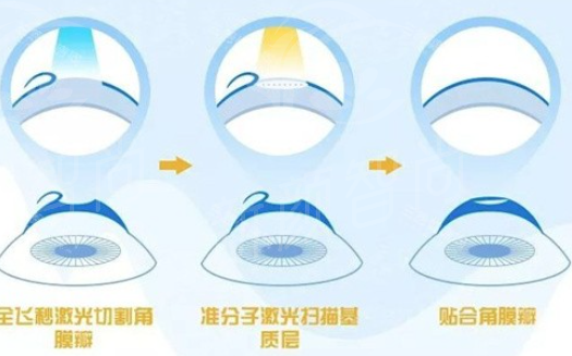 广州视可佳眼科：高度近视全飞秒/白内障/视力矫正