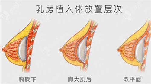 我找杭州清锴医疗美容门诊部李保锴做了隆胸（亲测推荐），手法专业花费 3.5 万，效果超自然 -上新颜智尚小程序查询/咨询快捷预约