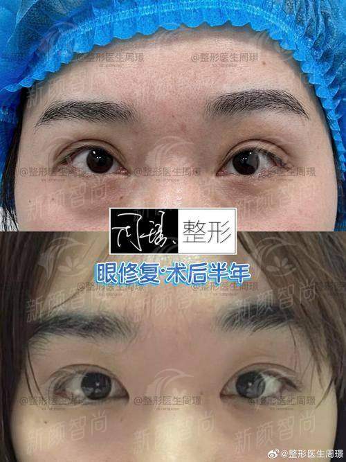 张冰洁眼修复口碑如何？北京客来美舍医生技术+术后效果全揭秘！ -上新颜智尚小程序查询/咨询快捷预约
