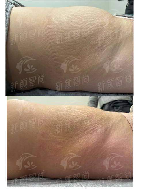 三、哈尔滨臻美全身吸脂修复期要多久？术后要注意什么？