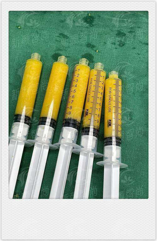 二、哈尔滨臻美全身吸脂做哪些部位？成效能维持多久？