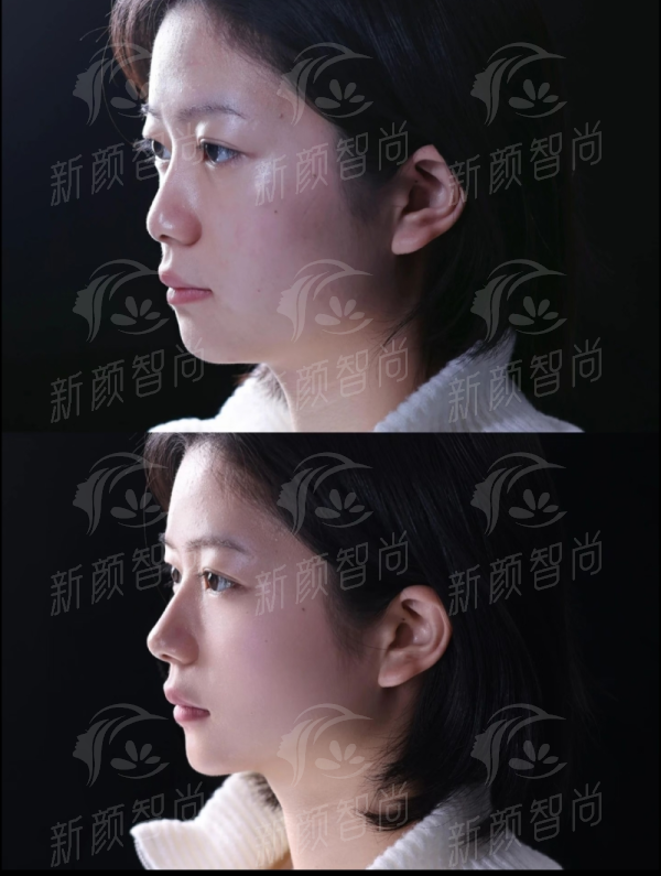 二、南昌佳美陈烈院长3D定制鼻综合术后成效如何？