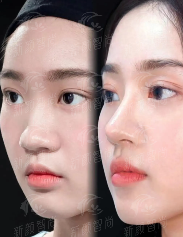 四、如何预约南昌佳美陈烈院长的隆鼻手术？