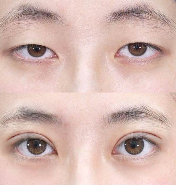 二、太原军大双眼皮医生白继平怎么样？网红风双眼皮骨干医生