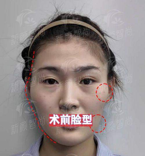 北京联合丽格何照华医生颧骨颧弓缩小术价格分析，术前术后对比效果一目了然！ -上新颜智尚小程序查询/咨询快捷预约