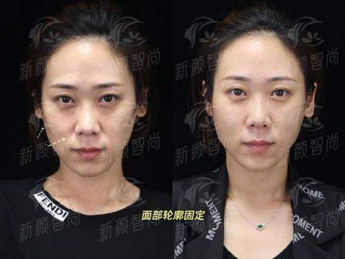 邓先超和柳超面部轮廓技术大PK！成都艾特他医院特色揭秘，新颜智尚小程序一键约，看案例谈价格！