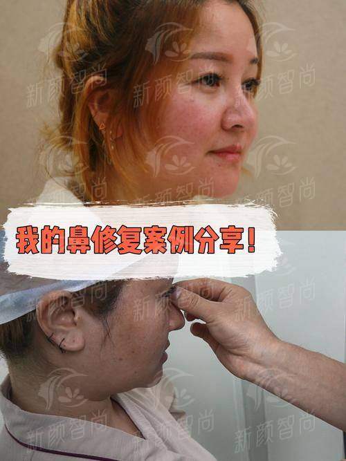 张龙医生鼻修复技术好在哪？杭州艺星自然妈生感，4.8万起价目表与用户反馈 -上新颜智尚小程序查询/咨询快捷预约