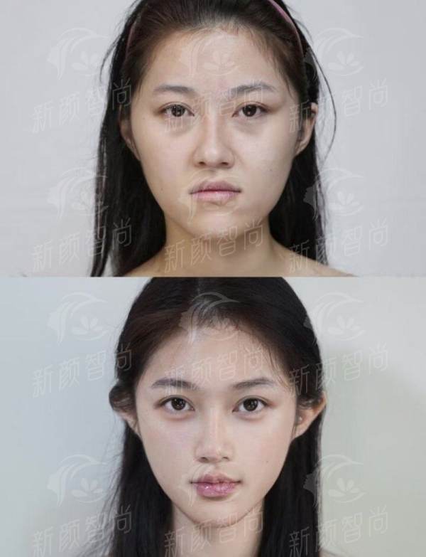 3步搞定名医预约！北京蒂凡妮王志坚医生唇裂修复深度解析，附“Z”字术价格与效果对比！新颜智尚小程序预约流程全公开，更快约上少等待