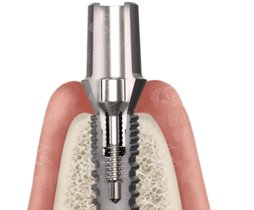 三、<strong>深圳正恩口腔医院(罗湖总店)</strong>数字化诊疗：德国卡瓦设备护航，种牙更准更舒适