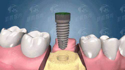 二、深圳柏齿康口腔门诊部（罗湖院区）——数字化黑科技加持，告别“盲人摸象”式看牙