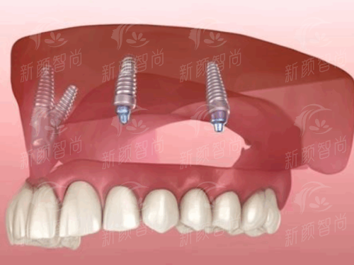 四、<strong>深圳正恩口腔医院(罗湖总店)</strong>2026年价格表：收费透明，性价比极高无隐形消费