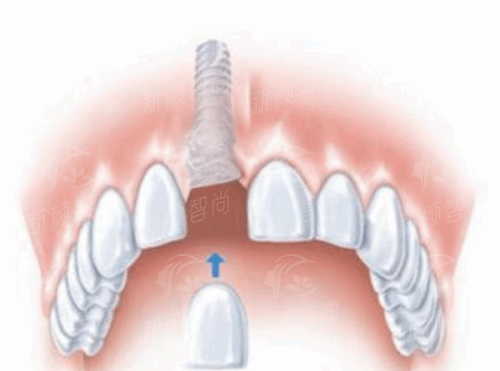 上海优目佳科崇视门诊部怎么样?看近视手术真实口碑与价格,上新颜智尚小程序挂号不踩坑
