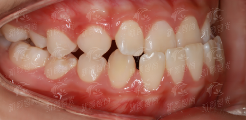 深圳爱康健口腔医院（罗湖院区）四、数字化黑科技加持，种牙矫正舒适度Max