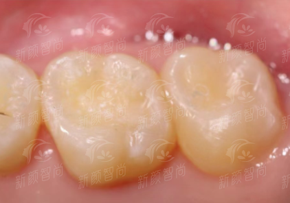 深圳口腔科推薦：羅湖區人民醫院(春風院區)種植牙、矯正價格表，新顏智尚小程序預約掛號更便捷