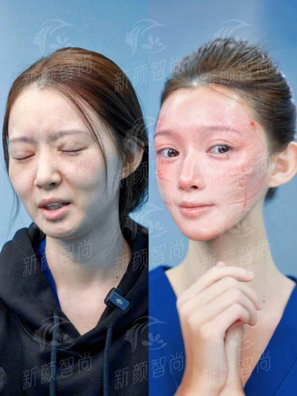 三、上海市东方医院整形外科吸脂塑形：拒绝“注水感”，打造妈生款好身材