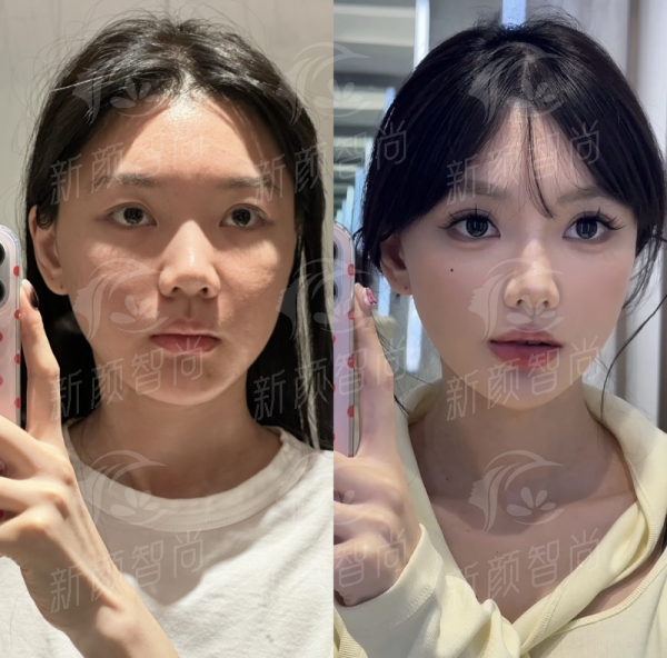 三、济南李辉眼鼻整形美容门诊部——揭秘YS原生鼻专项技术,告别“猪鼻子”