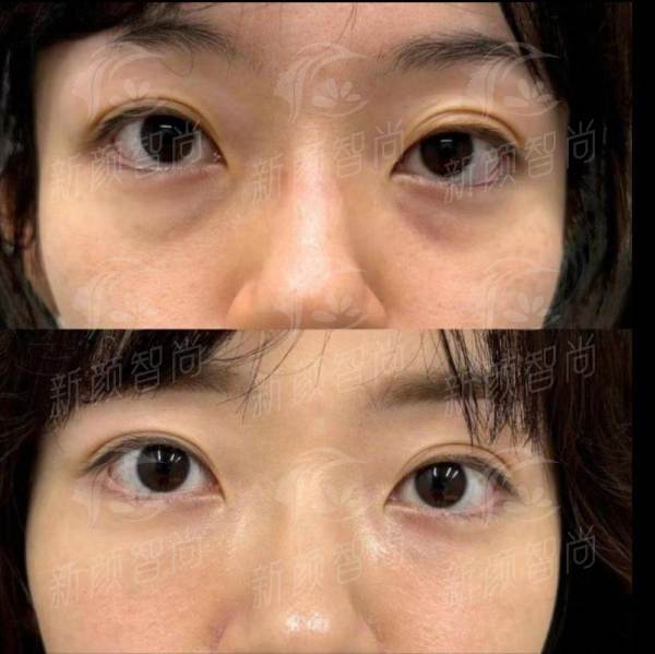 济南李辉眼鼻整形口碑如何？看这份真实案例分享，附新颜智尚小程序预约方式大公开