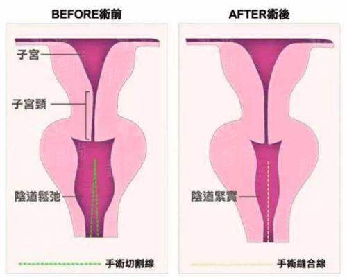 五、温州眼视光医院整形科真实实例：她们的眼眸“重生”记