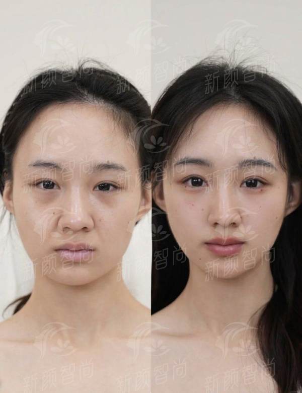 成都熙朵植发医院:五、真实实例分享,发友的“逆袭”日记