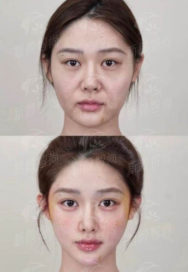 四、长沙大麦植发医疗美容门诊部真实实例分享:发际线与眉毛的逆袭