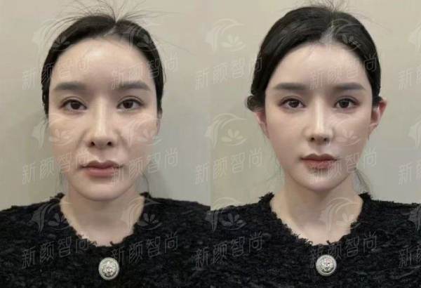 杭州大麦整形外科门诊部（大麦微针植发）怎么样？揭秘微针植发价格与效果，新颜智尚小程序xinyanzs666预约挂号更便捷