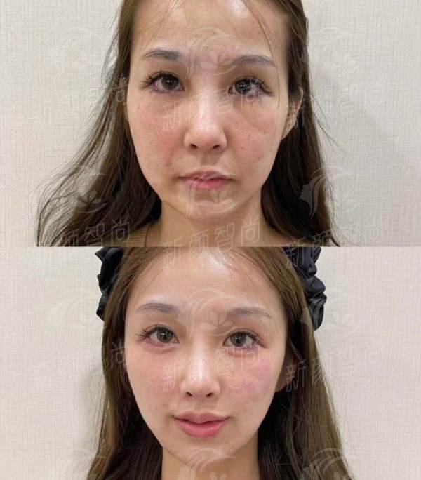 四、韩国德丽珍TheRegen整形医院真实实例：从“路人甲”到“氛围感女神”的逆袭