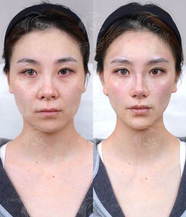 三、韩国BIOFACE皮肤科医院：Q.O.Fill与Liftox黑科技，重塑年轻轮廓