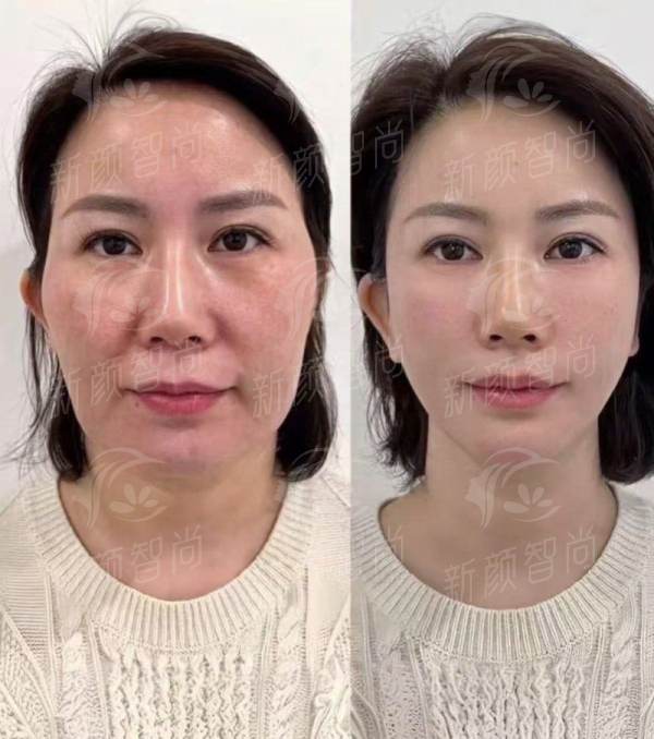 四、韩国布莱克植发医院特色：男女分治，定制你的“高容貌”发际线