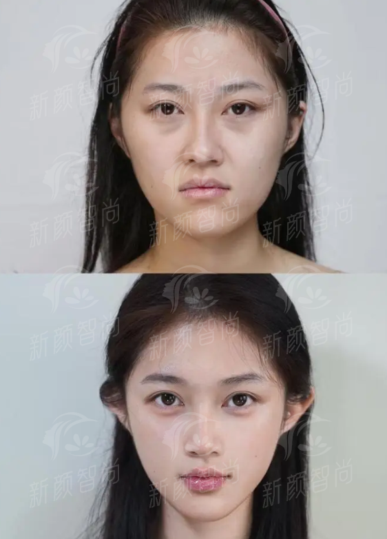 四、绍兴柯桥金柯桥医院医疗美容科:眼鼻胸皮肤全线出击,真实实例说话