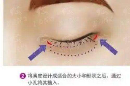 杭州杭冰美至优美医疗美容诊所怎么样？口碑爆棚的医美机构，附新颜智尚小程序xinyanzs666预约挂号更便捷