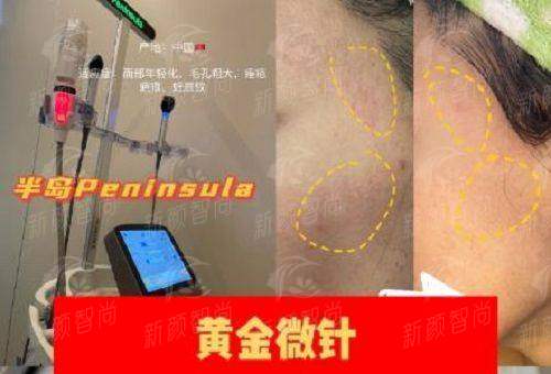 三、成都美茵医疗美容特色项目：不动刀也能拥有妈生感幼态脸
