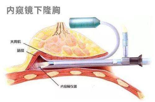 四、广州研媄荟医疗美容门诊部聂云飞医生:深平面拉皮提升,系统抗衰逆龄