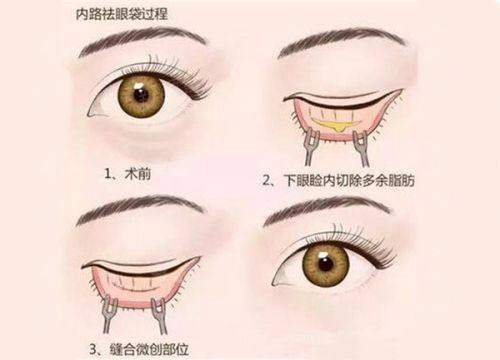 海南省眼科医院眼整形专科怎么样？揭秘双眼皮/眼袋手术价格与效果，附新颜智尚小程序预约方式大公开