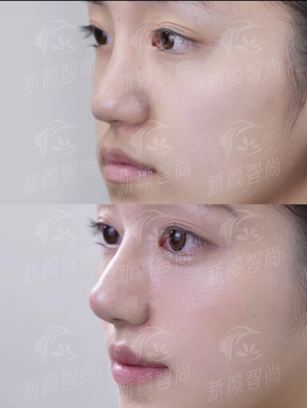 三、<strong style="color: red;">承德医学校附属医院(医疗美容科)</strong>：硬核设备加持，激光与手术双管齐下